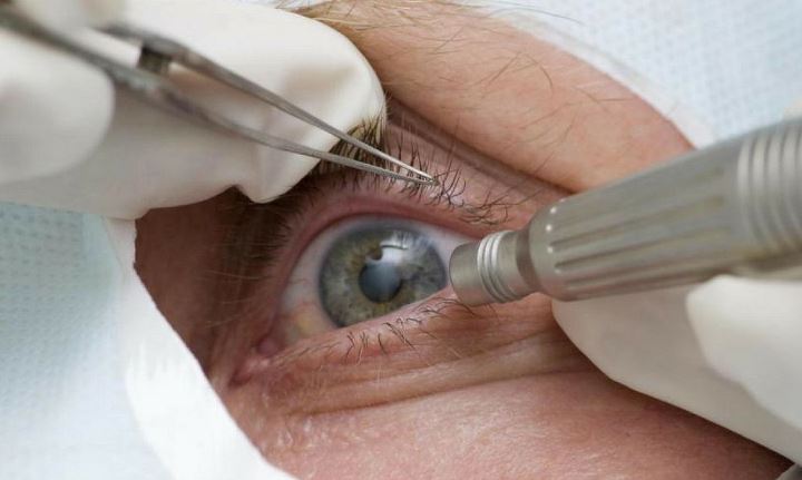 cirurgia de olhos